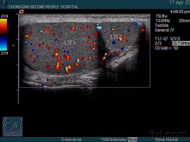 阴囊多睾症声像图