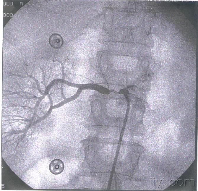 一组肾动脉狭窄的图片