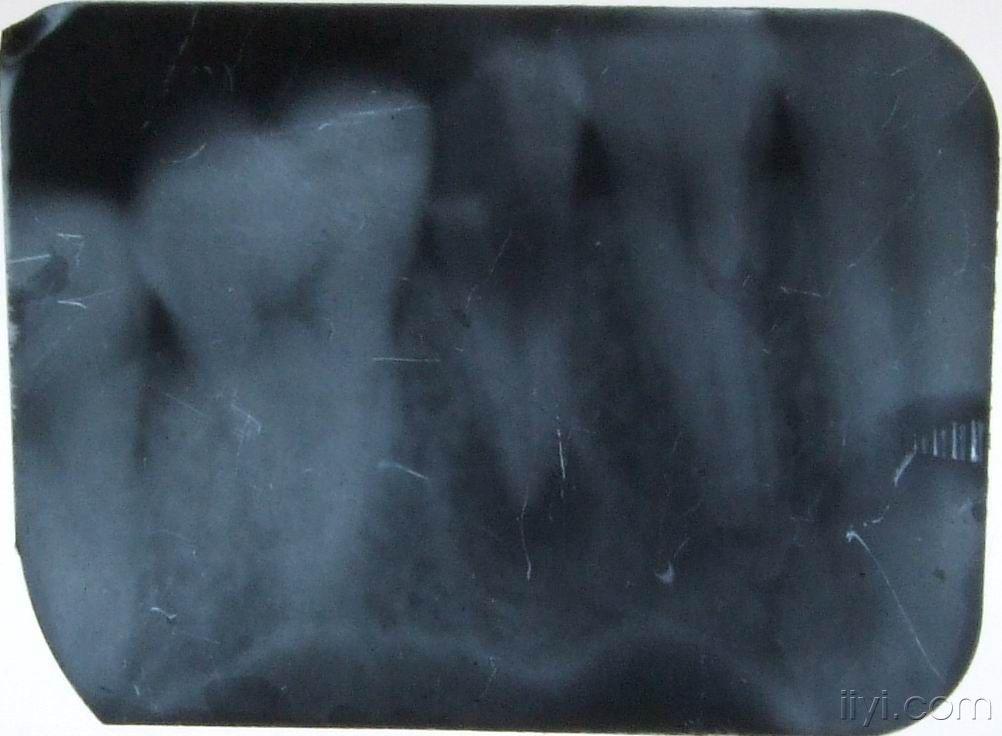 根尖处这样大的阴影《附牙片》要怎么处理最好!