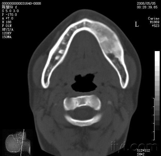 下颌骨骨纤维异常增殖?