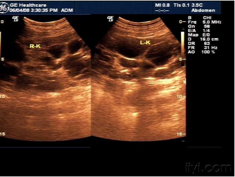 双肾多囊肾(献给新加入超声队伍的战友.