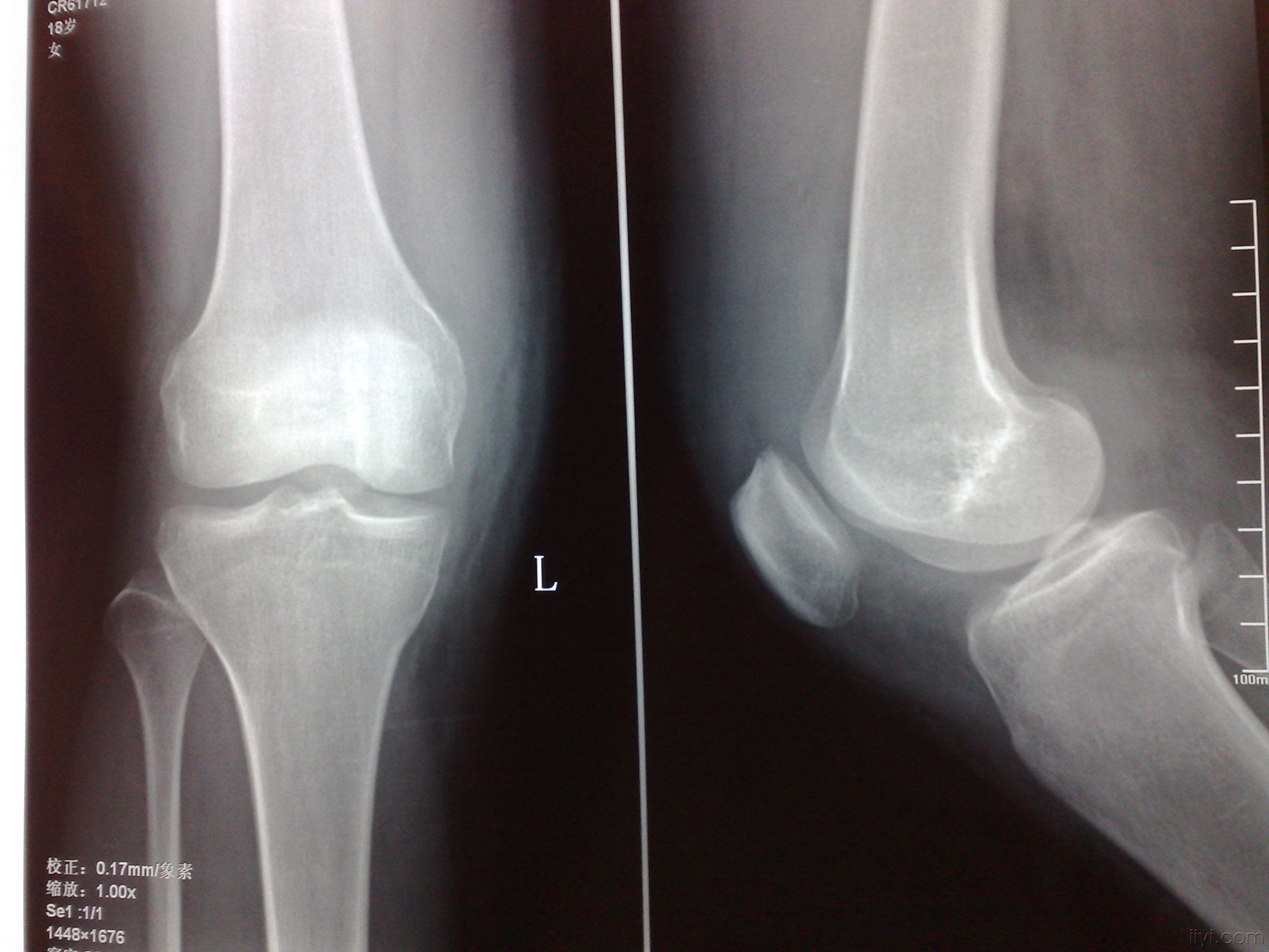膝关节x光图片图片