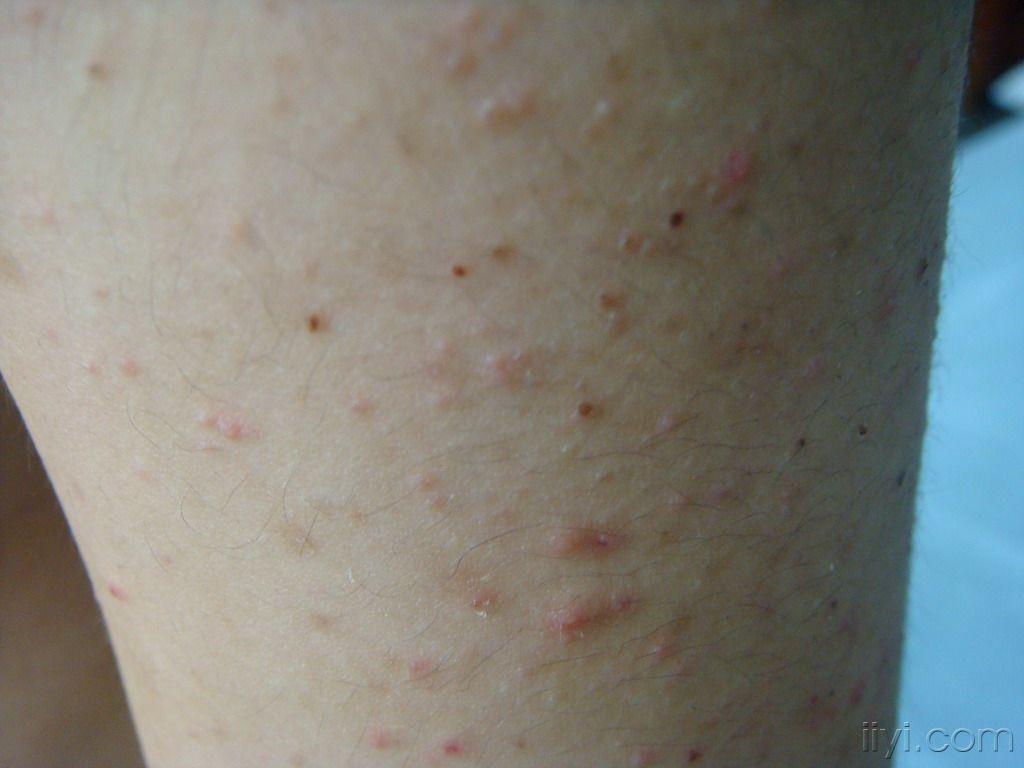 皮肤毛霉菌病图片图片