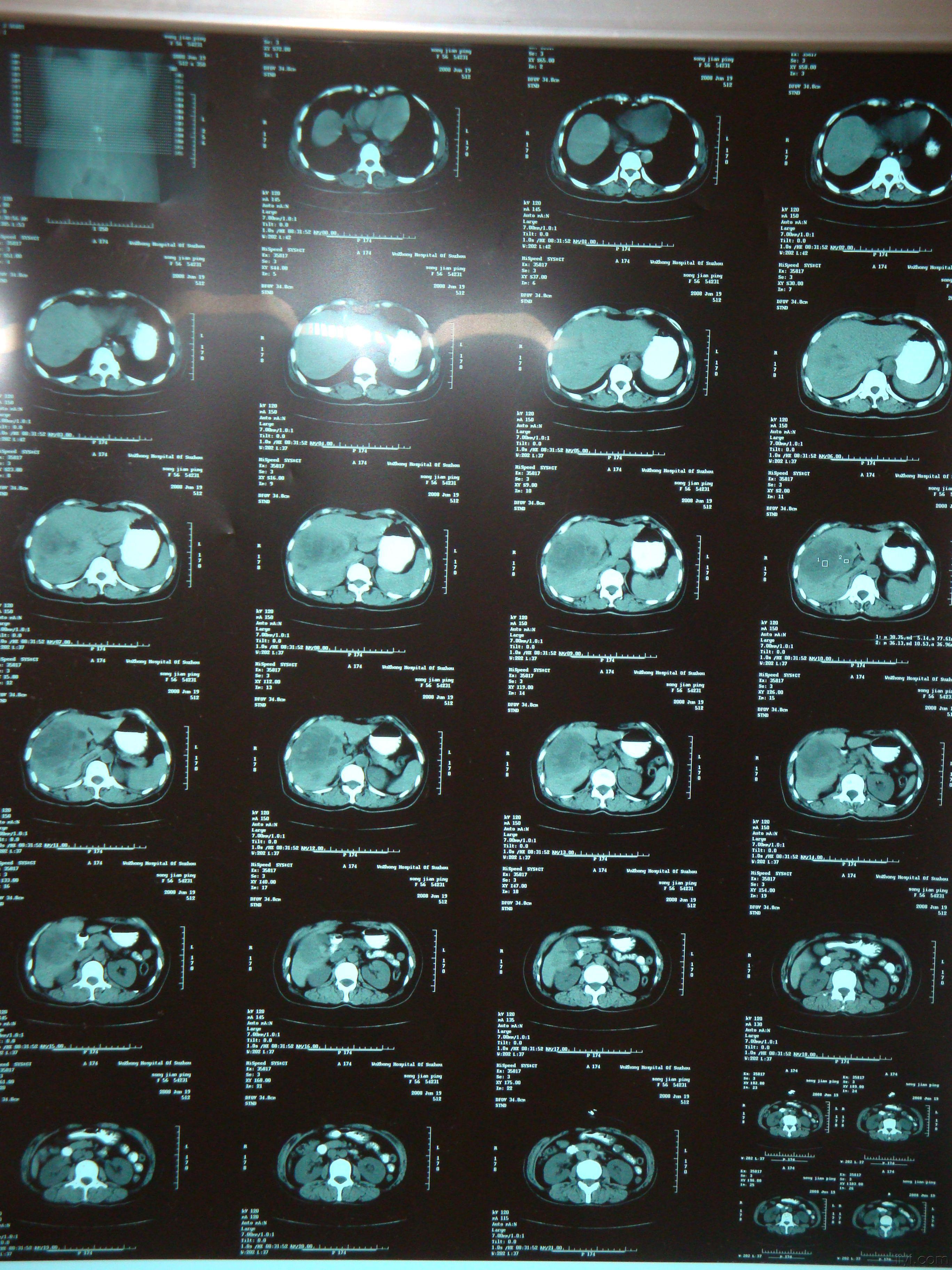 肝肿瘤ct显示图片图片