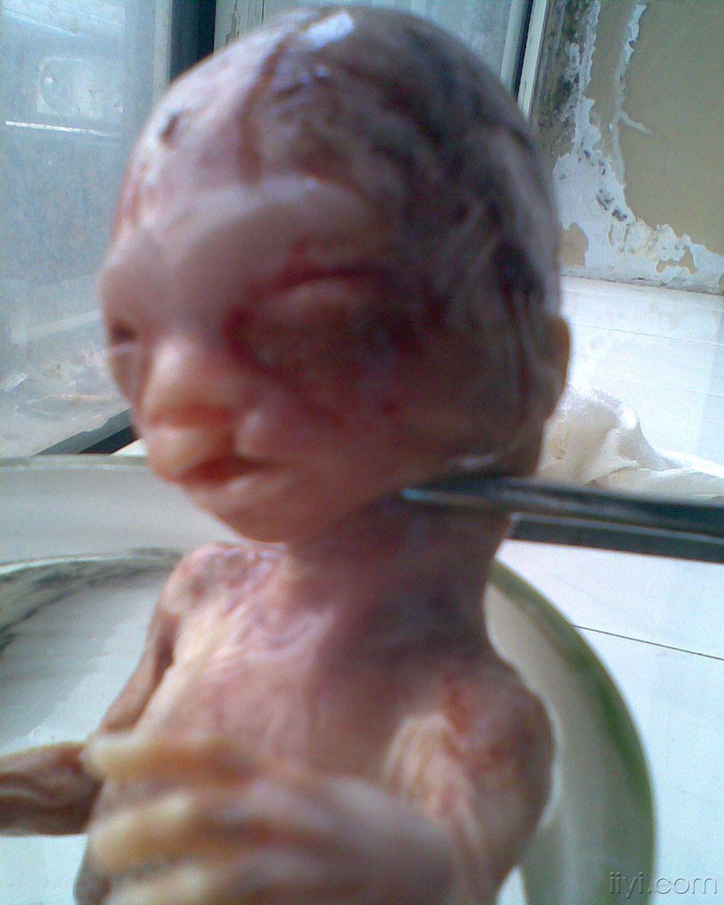 四个月胎儿图片(唇裂)
