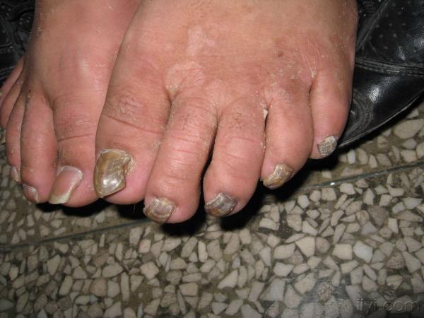 色素性毛表皮痣  4.颜面播散性粟粒型狼疮