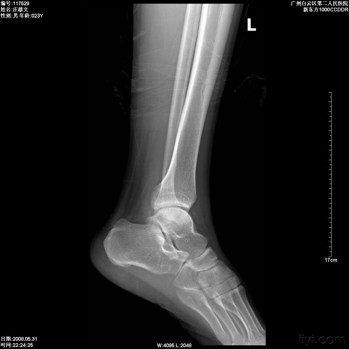 二例距骨病变,附ct