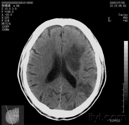 左侧基底节区脑梗塞图片