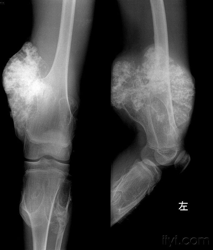 多发骨软骨瘤病的图片图片