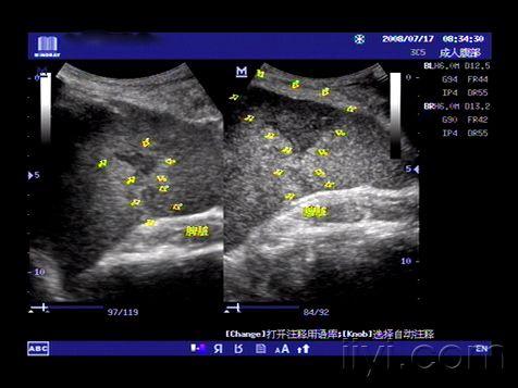 脾静脉超声图图片