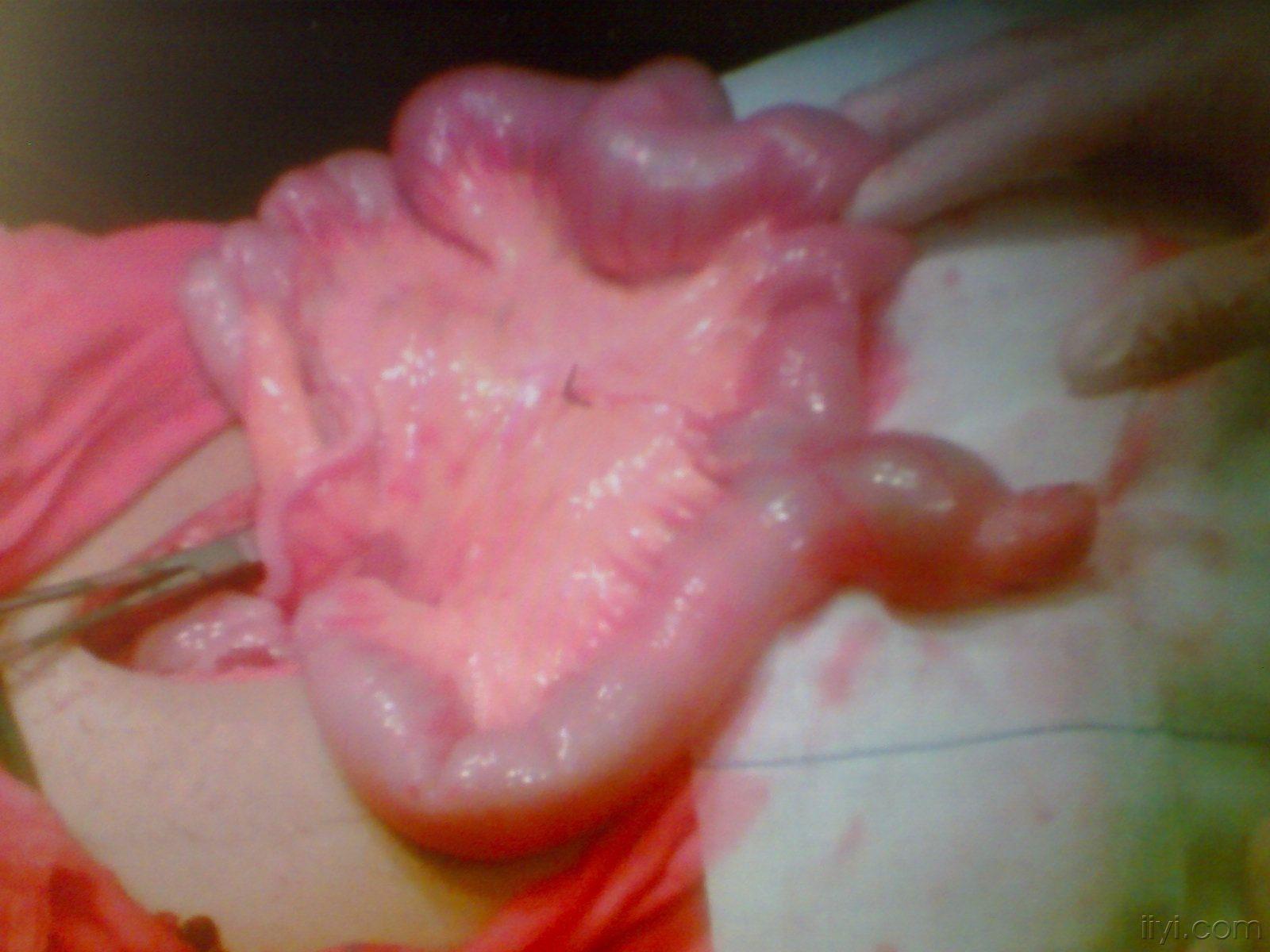 绝对原创!小肠憩室误诊阑尾炎一例