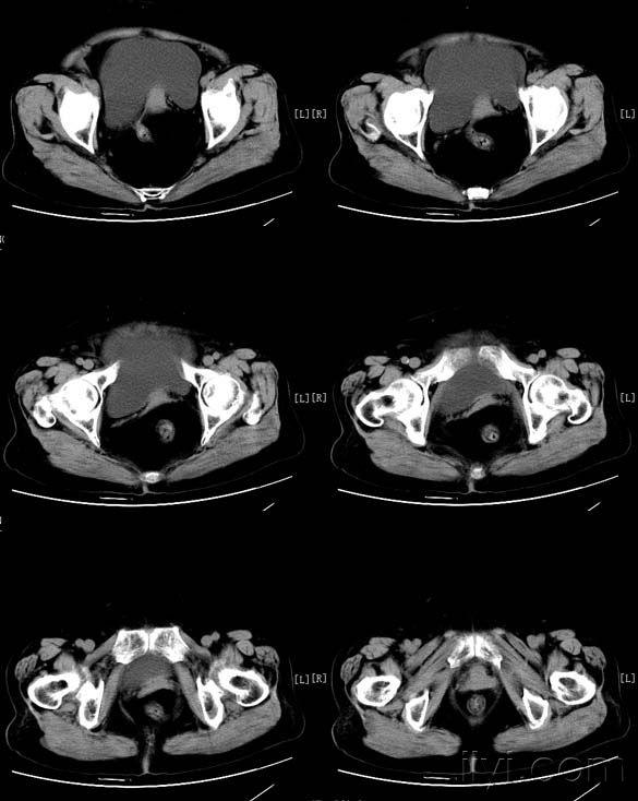 盆腔病变(卵巢乳头状浆液性囊腺瘤 )