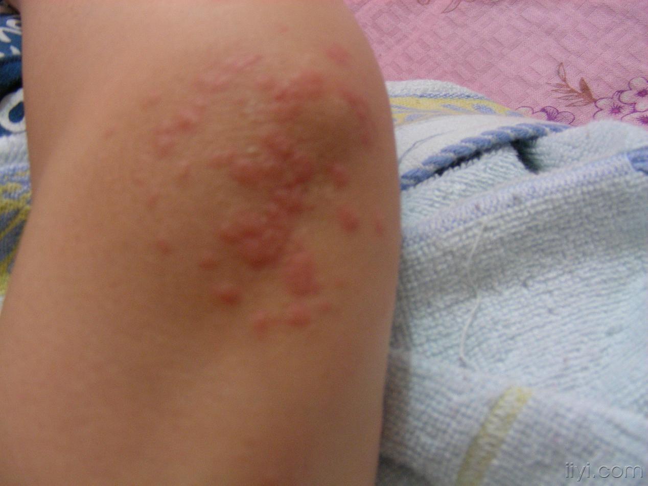 夏天发病,关节周围出现奇痒红斑,是什么病?