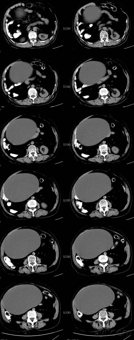 盆腔病变(卵巢乳头状浆液性囊腺瘤 )