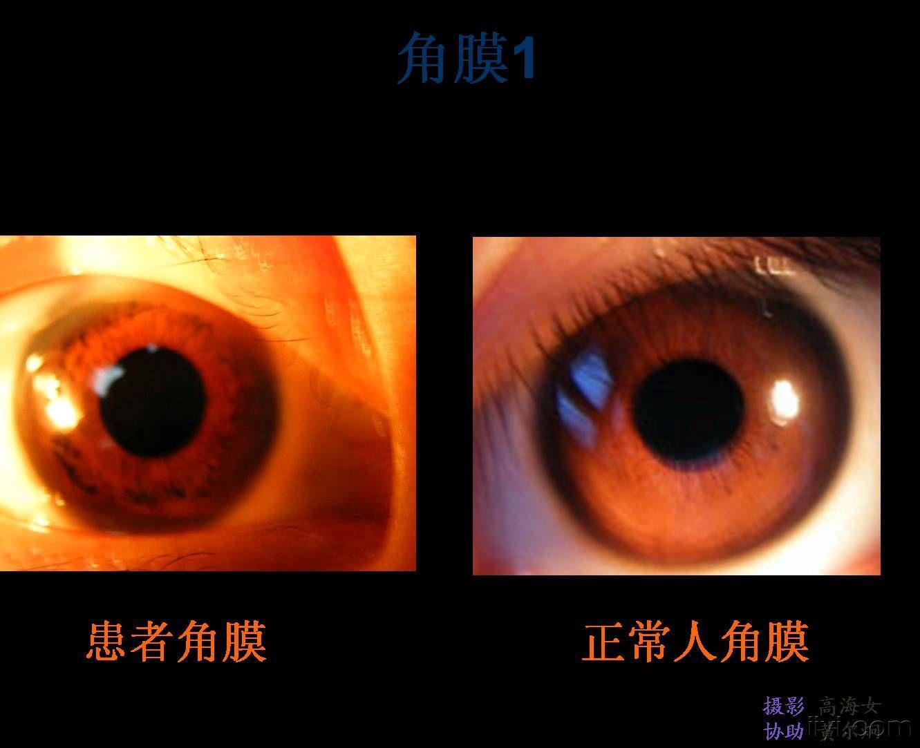 kf环的眼科图片图片