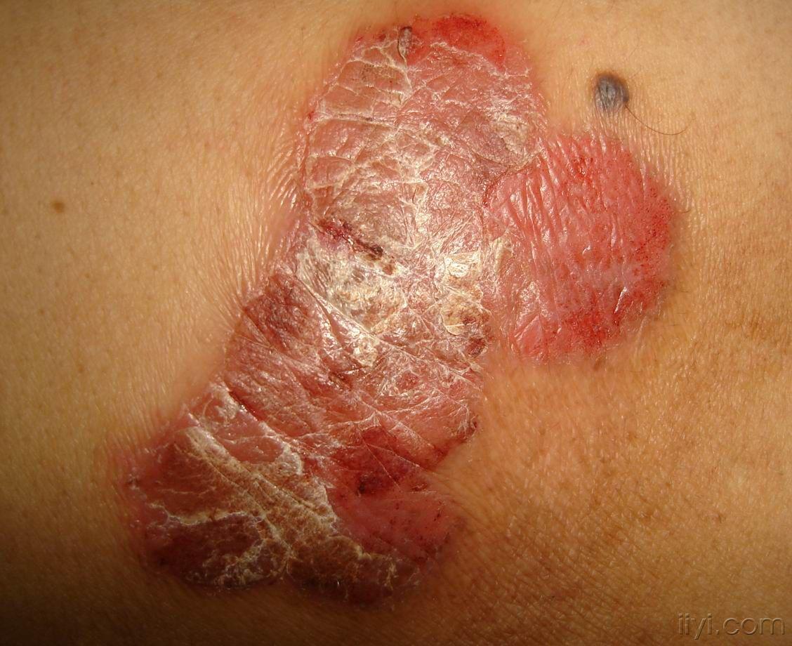 斑丘疹伴鳞屑5年余