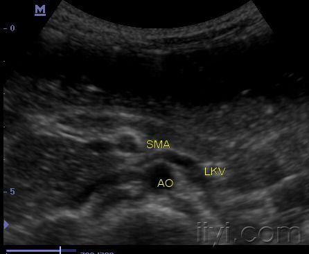 胡桃夹综合征超声表现图片