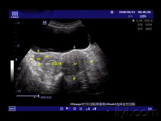 典型病例请欣赏-卵巢卵泡膜细胞瘤 超声医学资源版 爱爱医医学