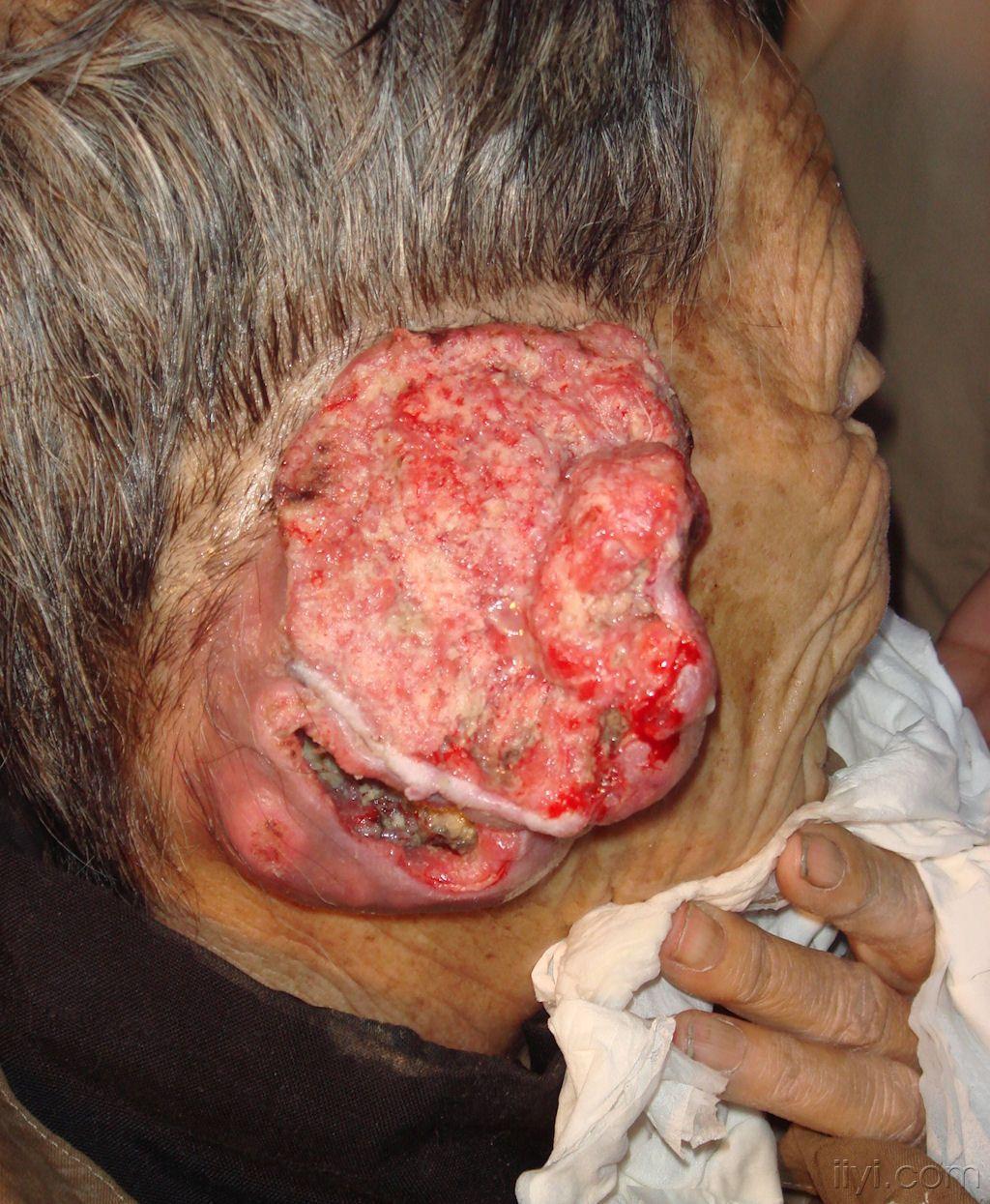 工作中遇到一例耳廓巨大肿瘤请大家讨论治疗方法