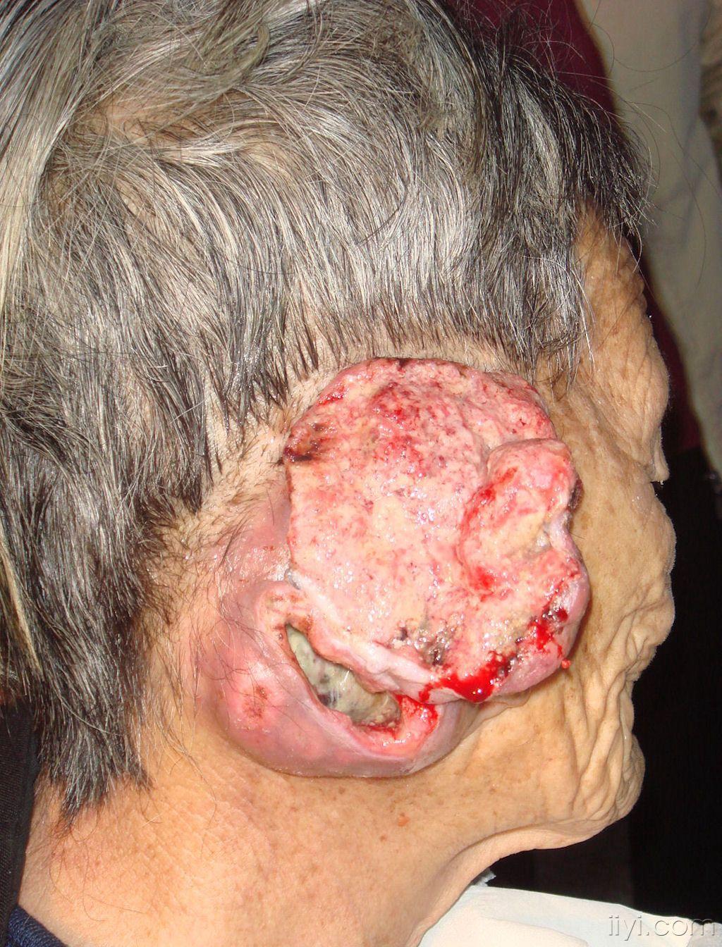 外耳道腺样囊性癌图片图片
