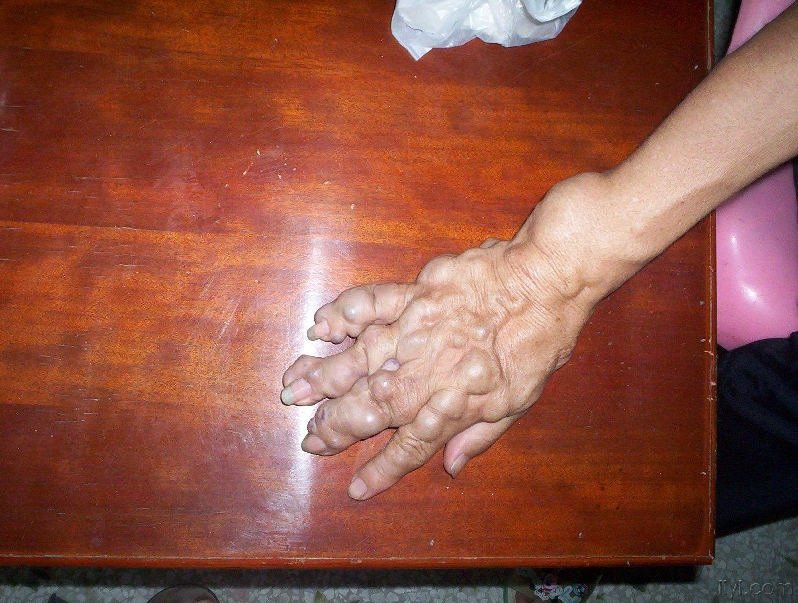 皮肤科摄影展的照片,愿意用做图谱的请把原图发到图谱征集帖!