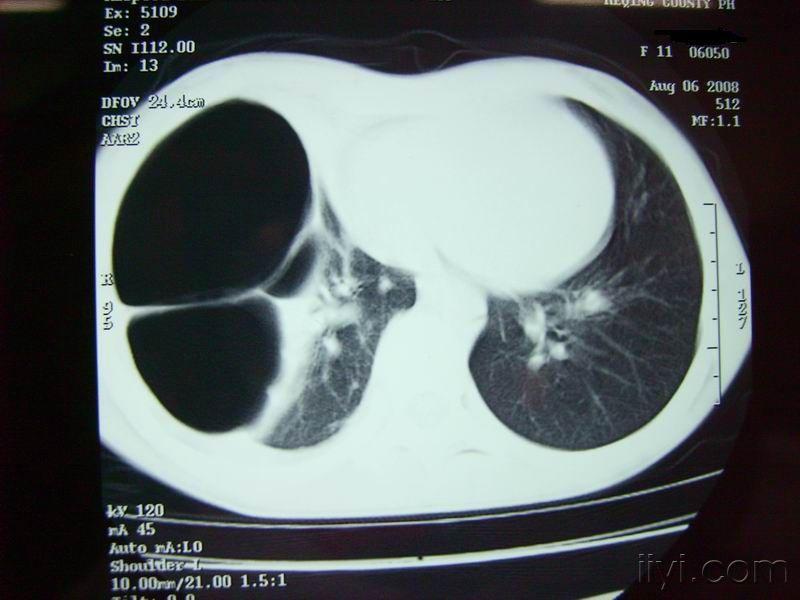 肺囊肿的ct片