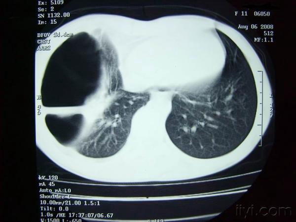 肺上结节80%是肺癌_肺部结节80%是肺癌_肺部有结节0.8cm癌指数高