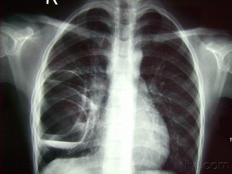 肺囊肿的ct片