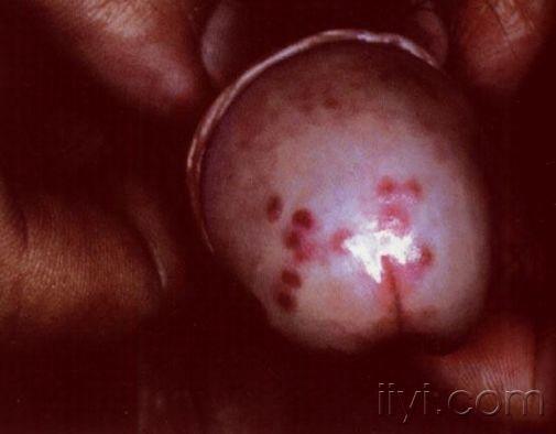 尿道口疱疹图片初期图片
