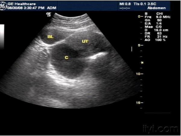 【讨论】子宫后方这个囊肿是左侧还是右侧.