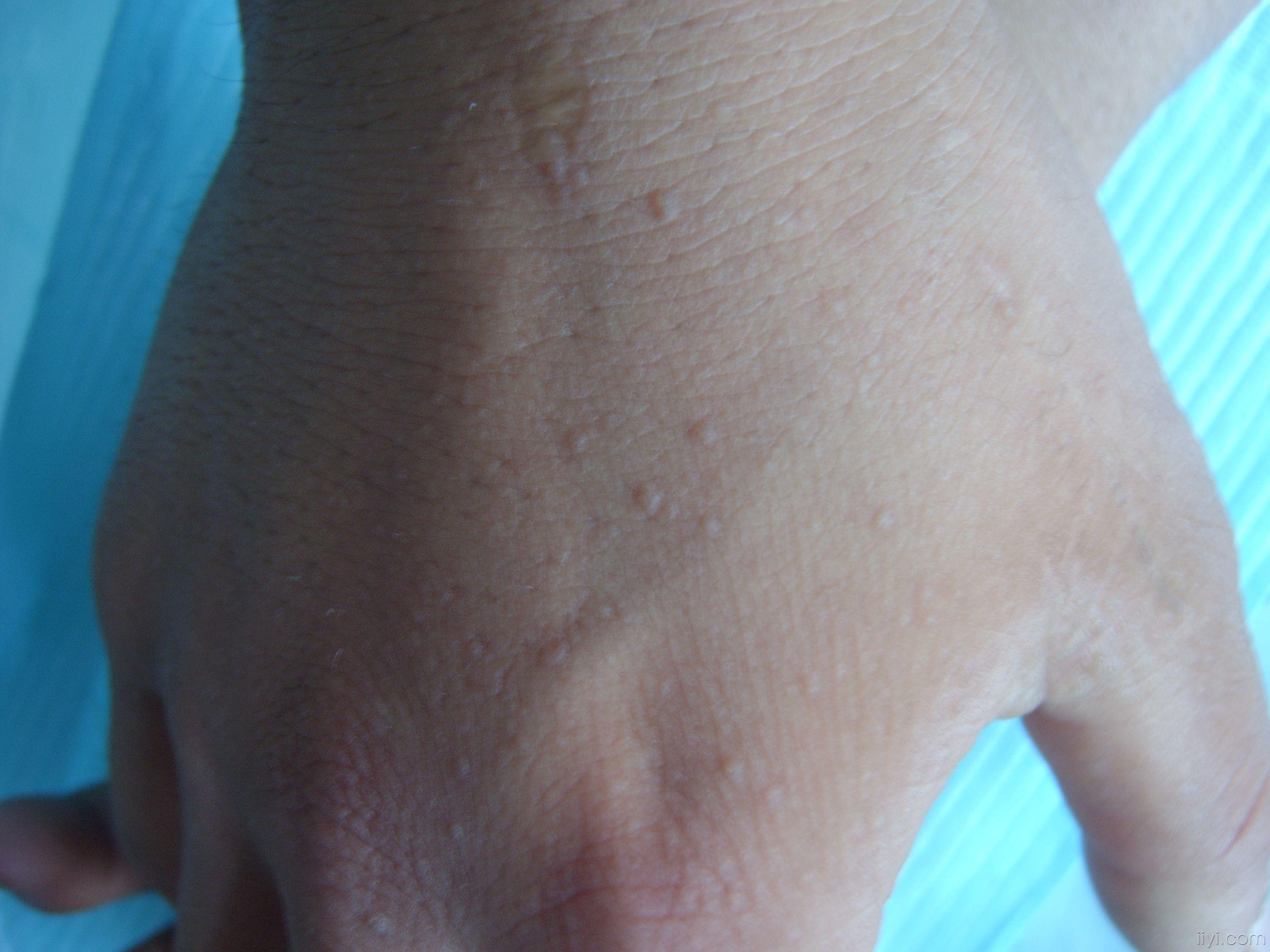 点状掌跖角化症