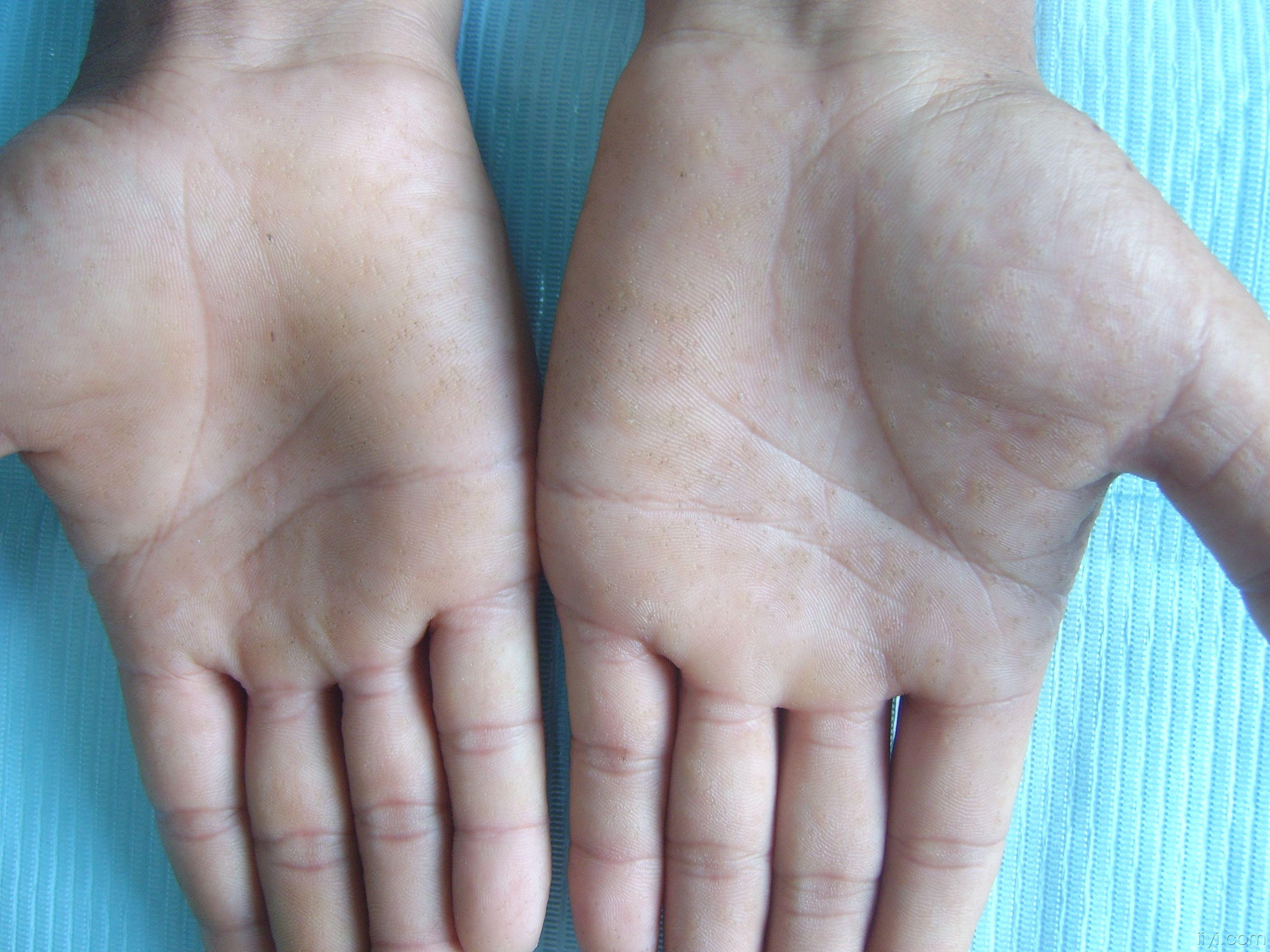 典型病历!点状掌跖角化症