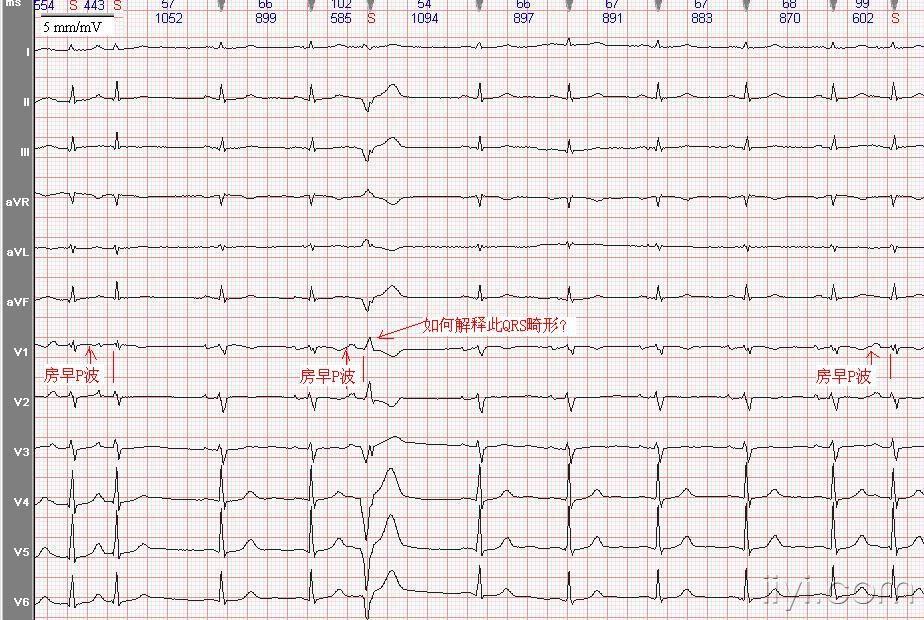 房早典型心电图特征图片