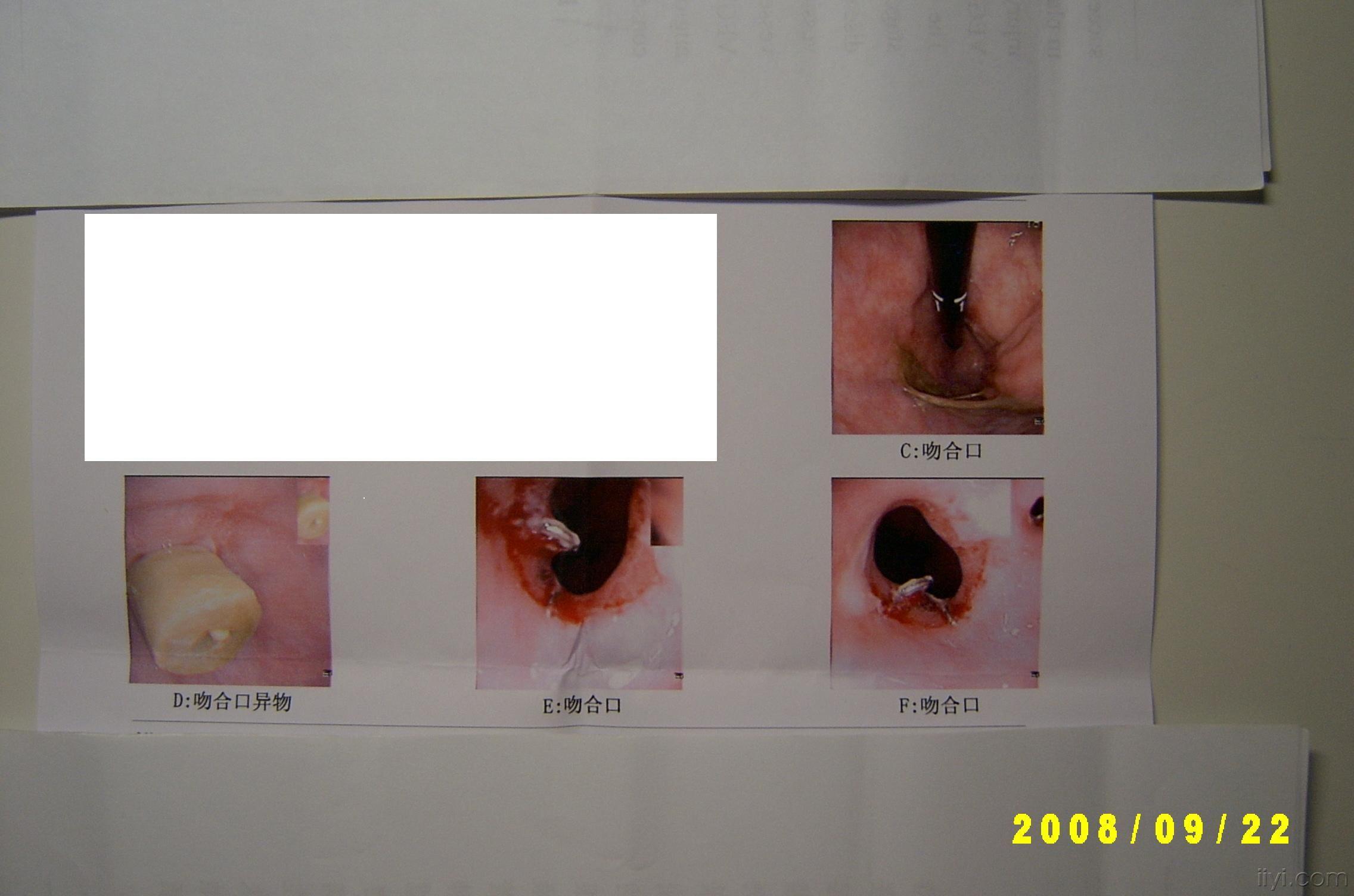 食管癌吻合器图片图片