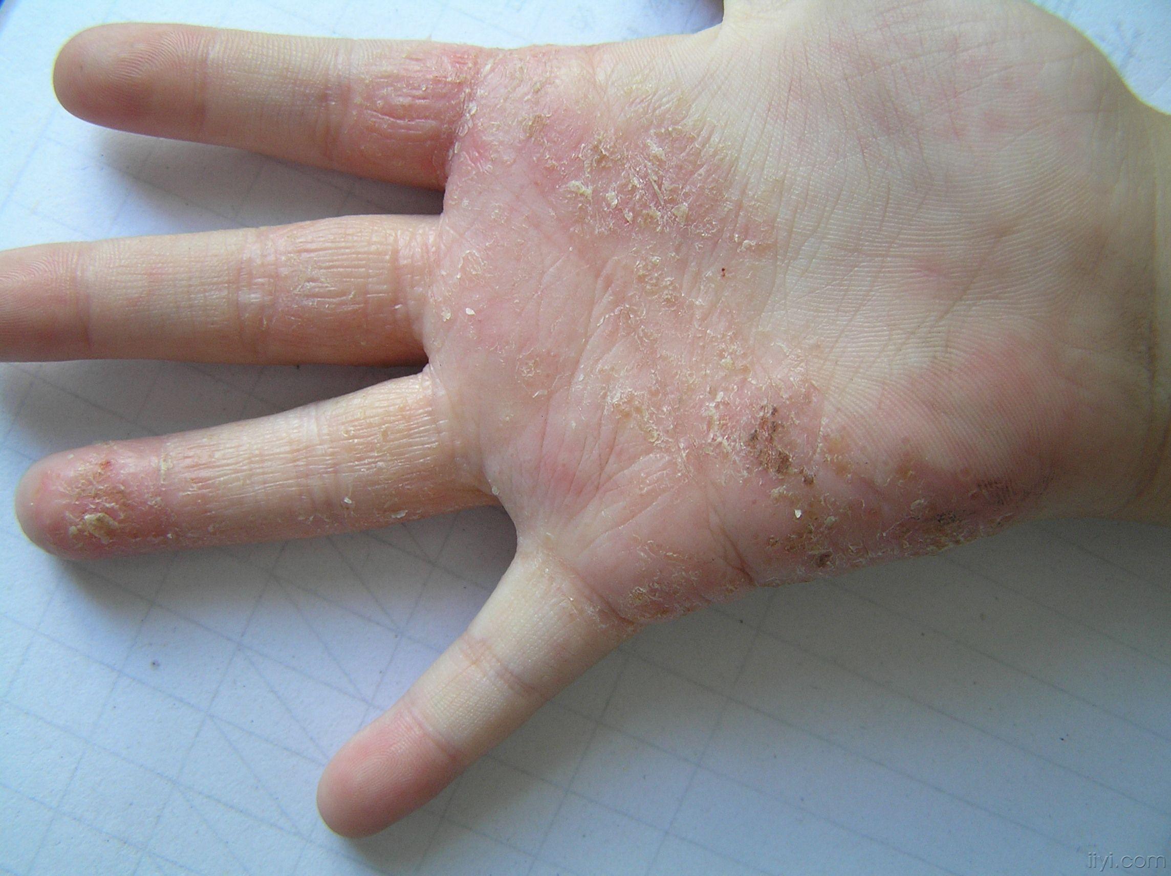 手掌湿疹症状图片