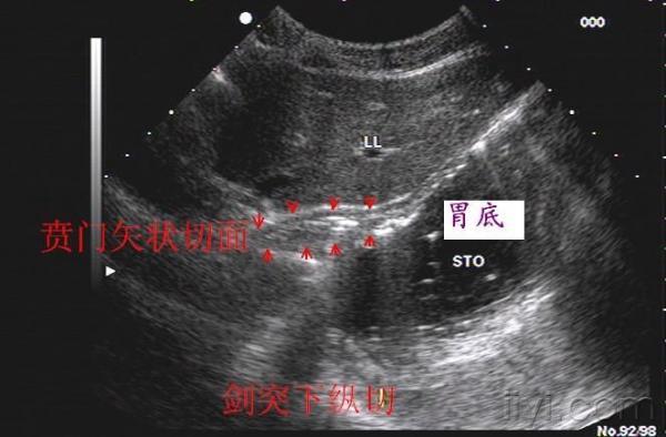 正常胃的超声图像图片