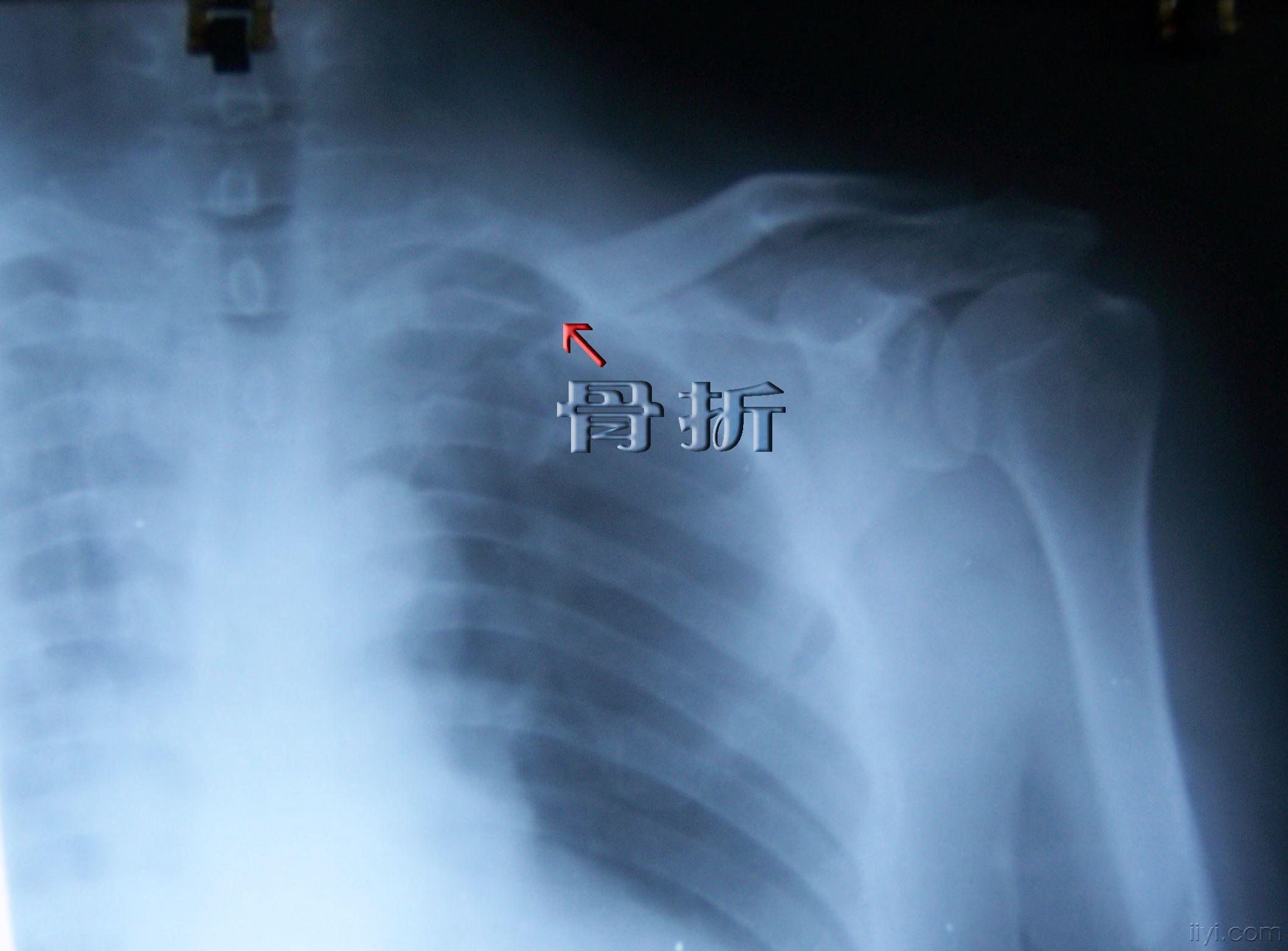 楼主chaoyang-wy2008-10-01 11:48:09患者女性,61岁,因摔伤致左锁骨近