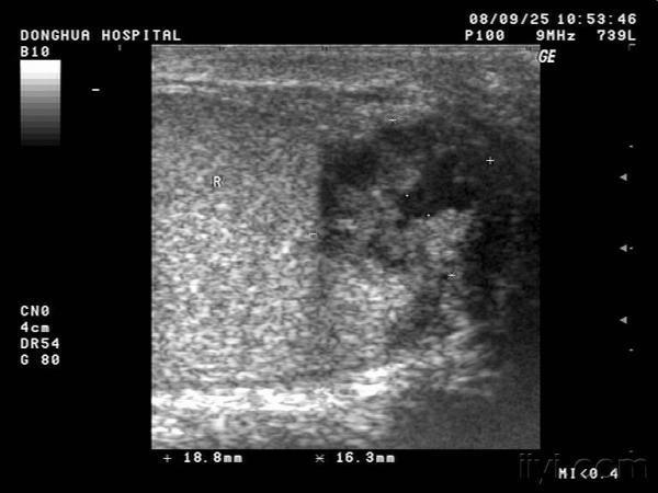 肾结核并侵犯睾丸(有病理 超声医学讨论版 爱爱医医学论坛