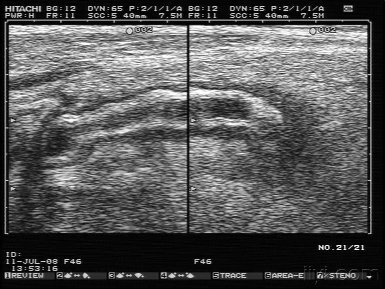 阑尾炎超声图图片