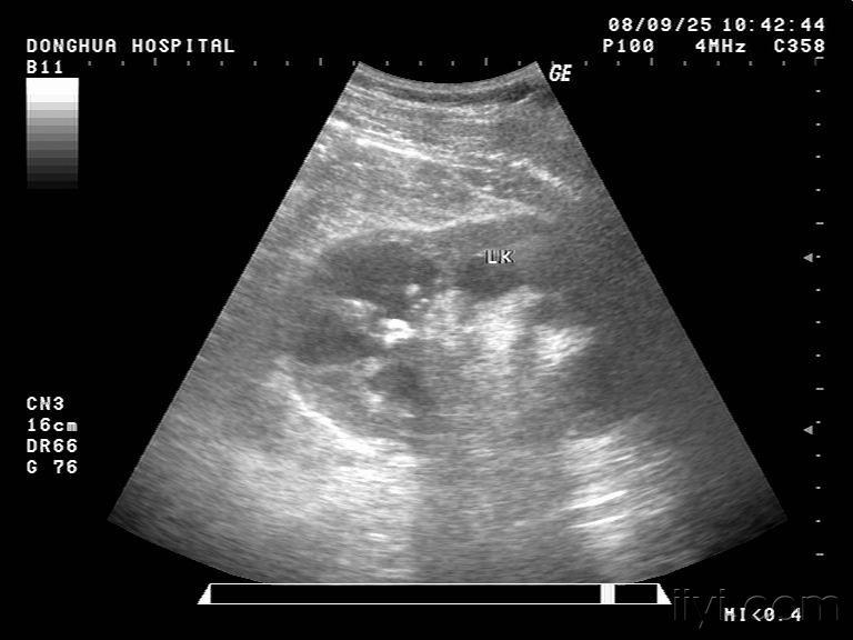 肾结核并侵犯睾丸(有病理 超声医学讨论版 爱爱医医学论坛
