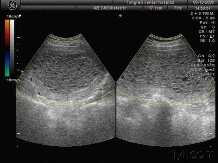 【贴图】典型葡萄胎 超声医学资源版 爱爱医医学论坛 爱爱医