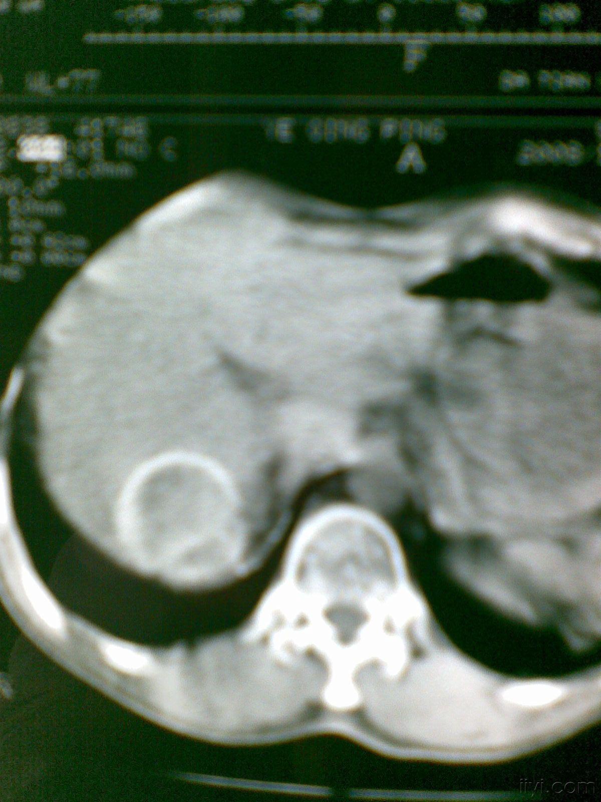 肝钙化灶的彩超图图片