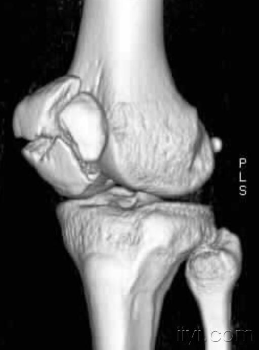 病例討論(髕骨粉碎性骨折)
