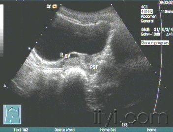 前庭大腺囊肿超声图片图片
