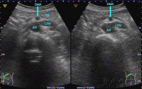 胡桃夹综合征超声图片