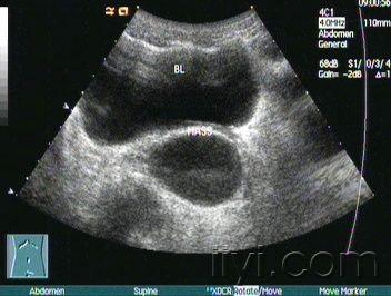 精囊腺超声图片图片