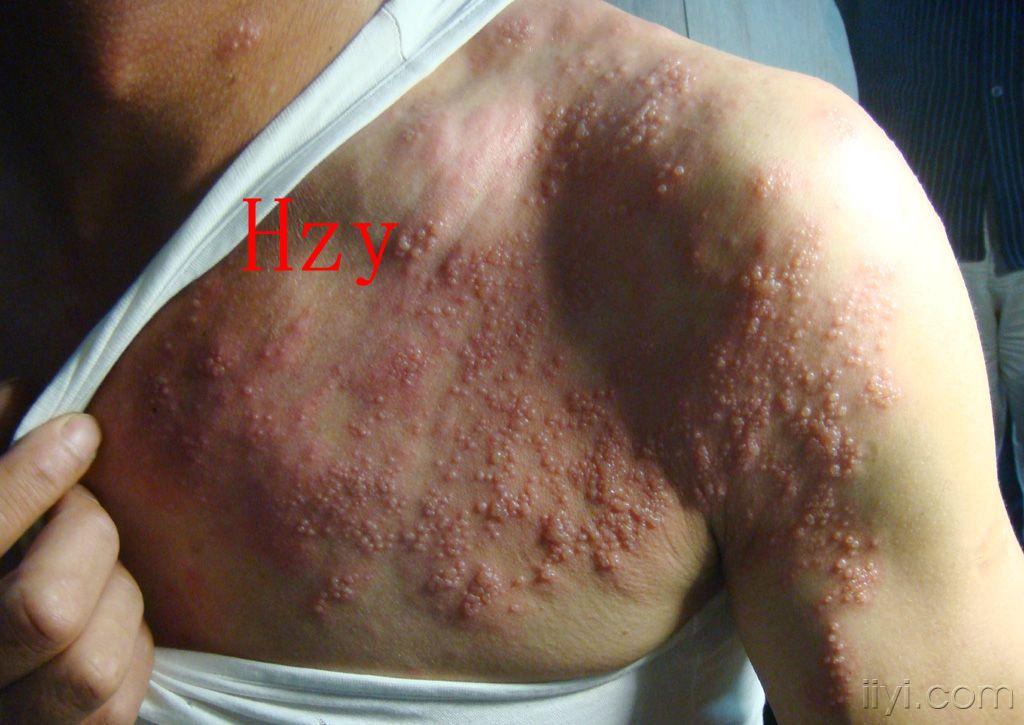 他左胸部的大片皮损是什么?
