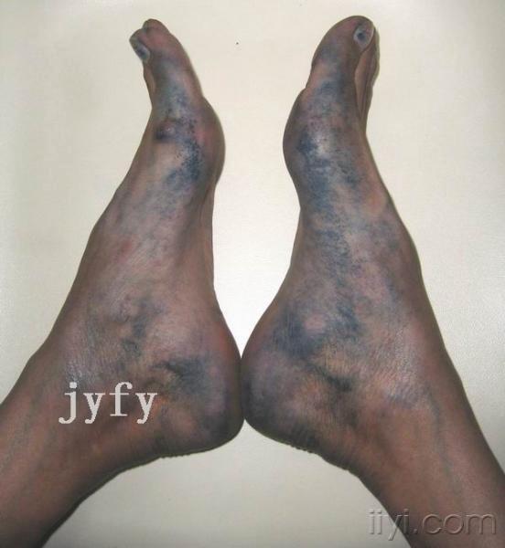 罕见蓝汗症 - 皮肤及性传播疾病讨论版 - 爱爱医医学论坛 - 爱爱医