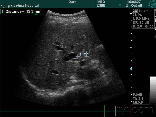 肝内胆管扩张超声图片