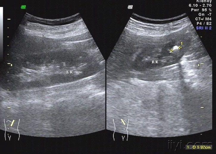 重复肾超声表现图片图片